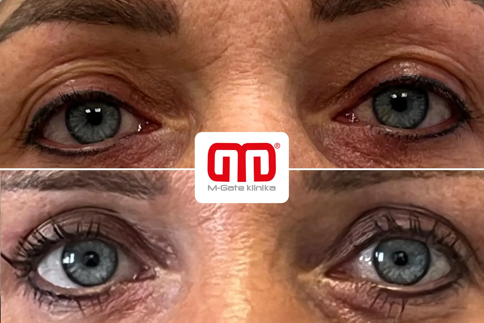 Operace víček - 11